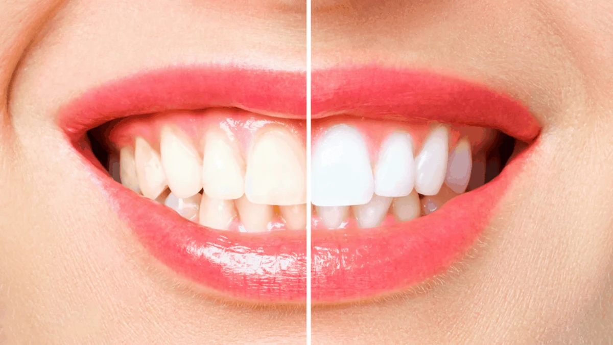 Professional Teeth Whitening Wasilla, AK